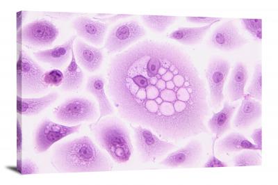 HPV-16 E5 Oncoprotein, 2021 - Canvas Wrap