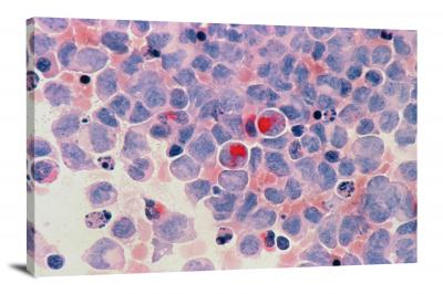 Acute Myelocytic Leukaemia, 2021 - Canvas Wrap