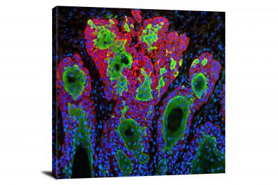 Squamous Cell Carcinoma, 2021 - Canvas Wrap